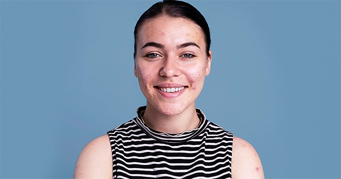 A girl with acne smiling genuinely and confidently | Trainest