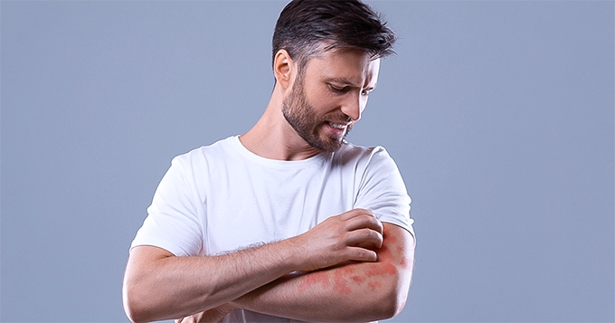 A man with allergy symptoms on his skin | Trainest 