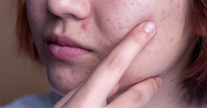 A woman with acne blemishes | Trainest 