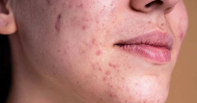 A woman with face acne | Trainest 