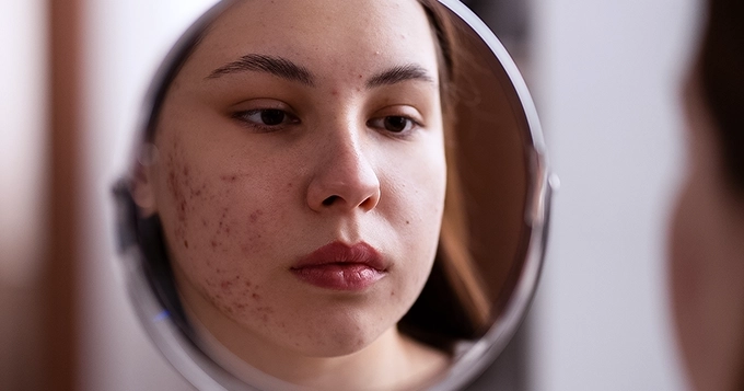 A woman with acne looking at herself in the mirror | Trainest