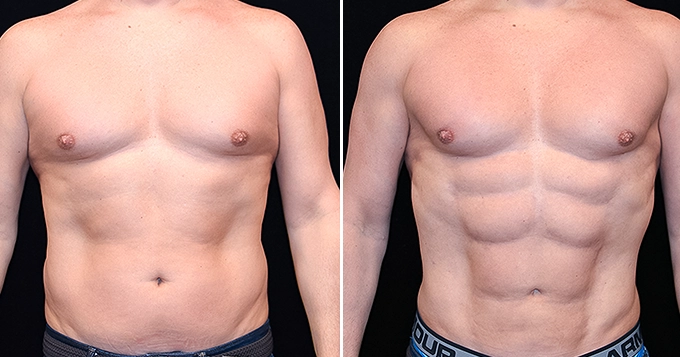 Show a close-up comparison of a before and after photo of someone's abs or stomach area | Trainest